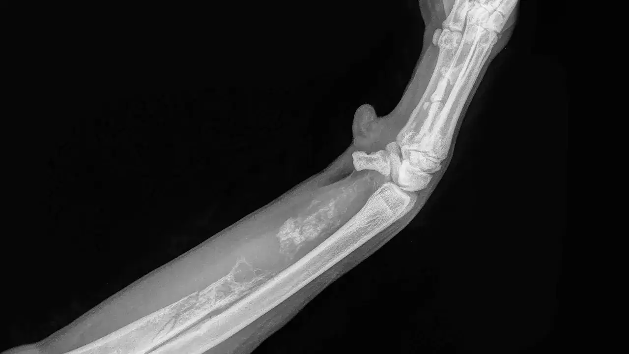 R&ouml;ntgenbild av en hunds framben visar tecken p&aring; osteosarkom, en aggressiv skelettcancer.